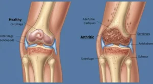 50대-이상-무릎-통증_-혹시-퇴행성-관절염-초기-증상